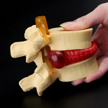 Juosmens Slankstelių Modelis Anatominę Stuburo Juosmens Disko Herniation Anatomija Medicinos Mokymo Priemonė Juosmens Slankstelių Modelis